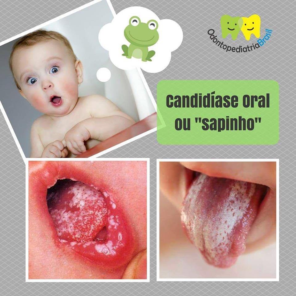 Candid Ase Oral Odontopediatria Brasil