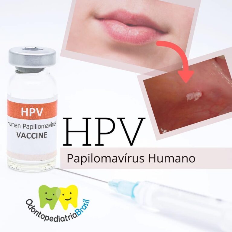 Hpv Papilomav Rus Humano Odontopediatria Brasil