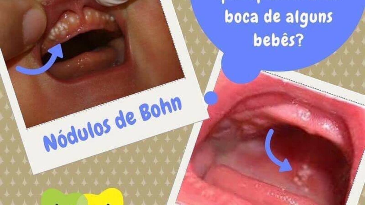 O que são Esses Pontinhos Brancos que Aparecem na Boca de Alguns Bebês? |  Odontopediatria Brasil