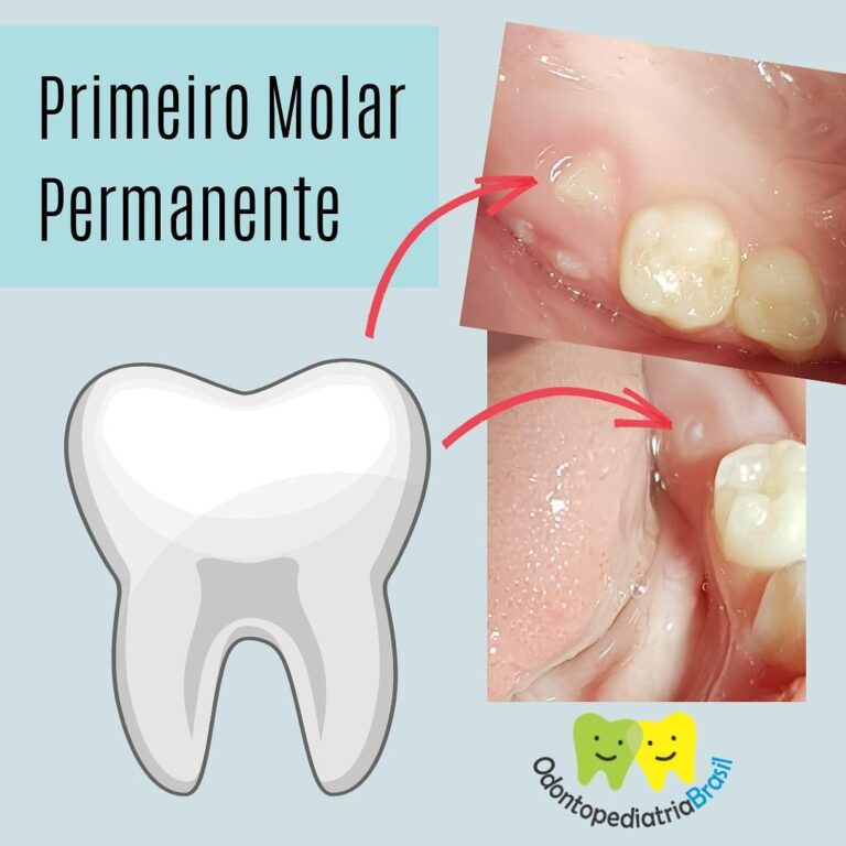 primeiro-molar-permamente-odontopediatria-brasil